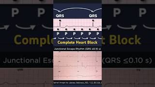 Third Degree Atrioventricular Block ECG Junctional Escape Rhythm [upl. by Adleremse]