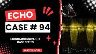 ECHO CASE 94  Echocardiography for Beginners  Echocardiogram Interpretation  2D Echo Basics [upl. by Sigismundo]