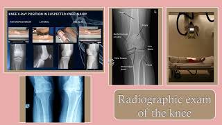 rad exam of the knee [upl. by Ahsinik]