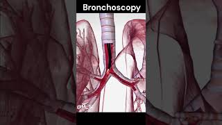 Bronchoscopy [upl. by Ydahs28]