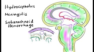 Hydrocephalus Meningitis and Sunarachnoid Hemorrhage [upl. by Renaxela]