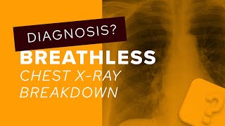 Chest XRay breakdown assessing the lung apices [upl. by Dnalloh3]