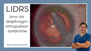 LIDRS lensiris diaphragm retropulsion syndrome Explanation and Demonstration [upl. by Hsirt852]