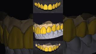 🦷👻 exocad cadcam dental dentist dentistry teeth [upl. by Assirrak]