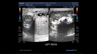 Ultrasound Video showing Epididymoorchitis Pyocele with septation Scrotal and Epididymal mass [upl. by Pazit]