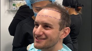 How to decide your Hair Transplant hairline height PT2￼ [upl. by Amleht102]