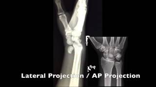 Perilunate vs Lunate Dislocation [upl. by Sefton]