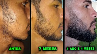 1 ANO E 4 MESES USANDO MINOXIDIL Pant Kirkland e Dom Pelo [upl. by Halehs653]