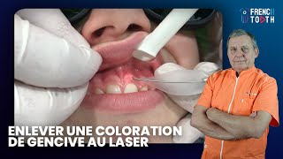 Comment enlever coloration de Gencive au Laser   Frank Pourrat [upl. by Rraval]