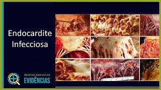 Endocardite Infecciosa  Aula [upl. by Anahsal]