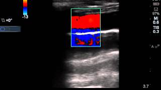 Pleural effusion  Fluid Color sign Probe 156 SLaX [upl. by Trinl]