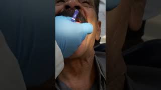 طريقه قياس posterior palatal seal المرحلة الخامسه صناعه اسنان complete denture [upl. by Arianne]