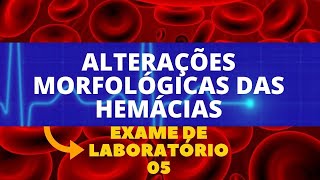 ANISOCITOSE POIQUILOCITOSE POLICROMASIA  ALTERAÇÕES NO HEMOGRAMA  HEMATOLOGIA [upl. by Ojadnama150]