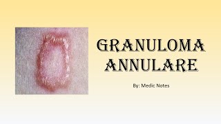 Granuloma annulare  associated conditions mechanism [upl. by Dana]