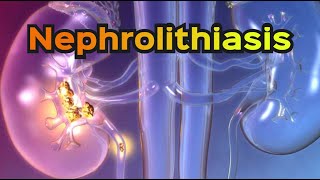 Nephrolithiasis Kidney Stones  CRASH Medical Review Series [upl. by Leahcimrej]