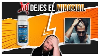 ESTO es lo que PASA si DEJAS MINOXIDIL [upl. by Burkle]