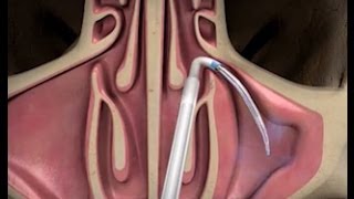 Balloon Sinuplasty Procedure with ENT Dr Timothy Ragsdale [upl. by Hplar]