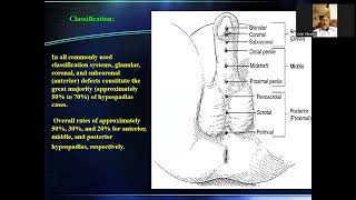 introduction to hypospadias أد عادل البكرى [upl. by Ardeed783]