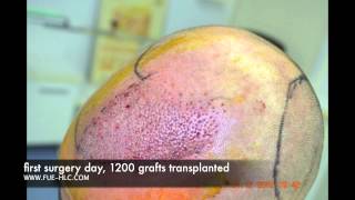 FUE Hair Transplant Hairline Clinic Ankara 2400 Grafts GREAT RESULTS [upl. by Aicenert]