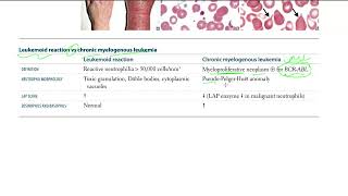 42 Leukemoid reaction vs chronic myelogenous leukemia [upl. by Anytsyrk]