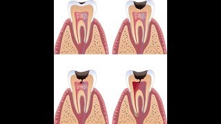 was ist karies  zahnkaries [upl. by Larianna]