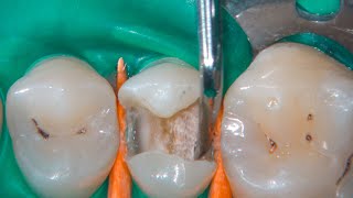 DRendo  Nonselective caries excavation the only correct clinical approach [upl. by Kennan]