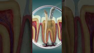 Root Canal Treatment  Curveia Dental I RCT [upl. by Htiderem]