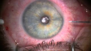 Stephen Slade MD Image Guided LASIK Flaps [upl. by Marysa108]