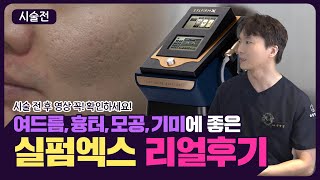 여드름 흉터 모공치료 한방에 끝내는 실펌X With 스킨부스터 엑소좀 ㅣ시술 효과와 후기 ㅣ [upl. by Edmund]