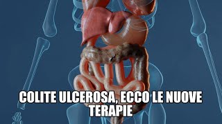 Colite ulcerosa ecco le nuove terapie [upl. by Pooley]