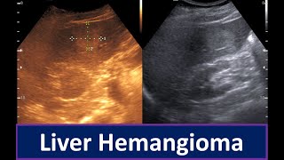 Liver Hemangioma on Ultrasound Key Sonographic Features  Hepatic Hemangioma [upl. by Egroeg150]