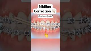 Midline Correction Braces  Orthodontics [upl. by Naylor535]