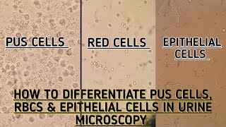 Interpretation of the Urinalysis Part 3  Microscopy and Summary [upl. by Sac]