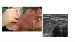 Fine Needle Aspiration FNA of the Thyroid Gland [upl. by Mccreery]