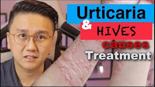 URTICARIA amp HIVES  Causes and Treatment of Itchy Skin Rash [upl. by Pamelina]