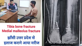 Tibia fibula bone and ankle medial malleolus fracture jhansi uttar pradesh se ilaj ke liye bharatpur [upl. by Anitahs]