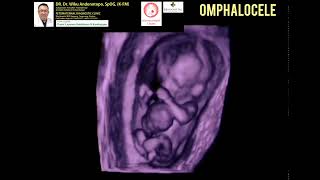 Omphalocele [upl. by Sivat94]