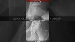 Slipped Capital Femoral Epiphysis Trethowan’s sign [upl. by Ardnasal392]