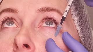 Way of work with Dermaheal Eye Bag Solution Caregen [upl. by Wyler]