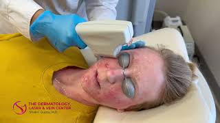 Levulan Photodynamic Therapy for Acne with Blue Light and Laser  Dr Shalini Gupta [upl. by Orest]