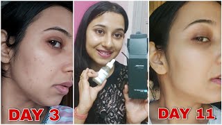 Best Serum For Oily Acne Prone Skin  Minimalist Niacinamide 10  zinc Serum Review with video clip [upl. by Laamak]