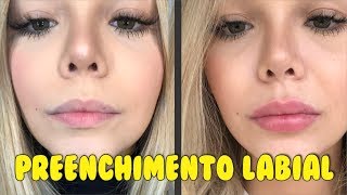 VLOG MEU PREENCHIMENTO LABIAL DOR PREÇO [upl. by Elttil]