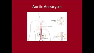 Management of Aortic Aneurysms [upl. by Derick]