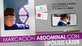 Marcación Abdominal Femenina con Lipolisis Laser Casos Bogotá  Colombia [upl. by Jaddo236]