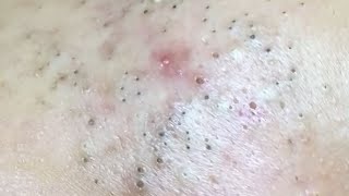 AWESOME FACIAL BLACKHEADS REMOVAL  Suri Job 146 [upl. by Einneb639]