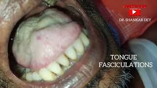 Tongue Fasciculations  Motor Neuron Disease  Amyotrophic Lateral Sclerosis  Dr Shankar Dey [upl. by Lewendal17]