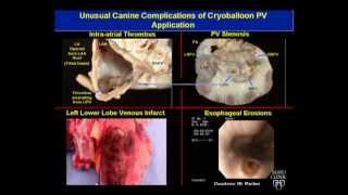 Avoiding Complications During Atrial Fibrillation Ablation  Dr Munger Mayo Clinic [upl. by Yttik]