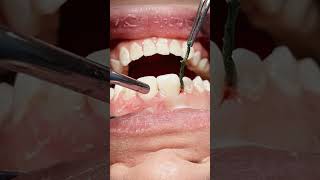 Class V tooth caries composite restoration dentisry [upl. by Dj241]