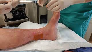 Venous Stasis Ulcer Bandaging and Dressing [upl. by Toney290]