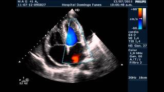 Pericarditis AgudaTaponamiento Cardiaco Dr Pedro Guillermo Bustos 12 Julio 2011 [upl. by Hollah]